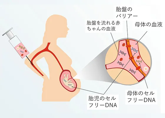 case2スーパーNIPTで陽性：羊水検査を受けずに出産