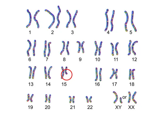 NIPT事例｜上のお子さんがプラダー・ウィリ症候群