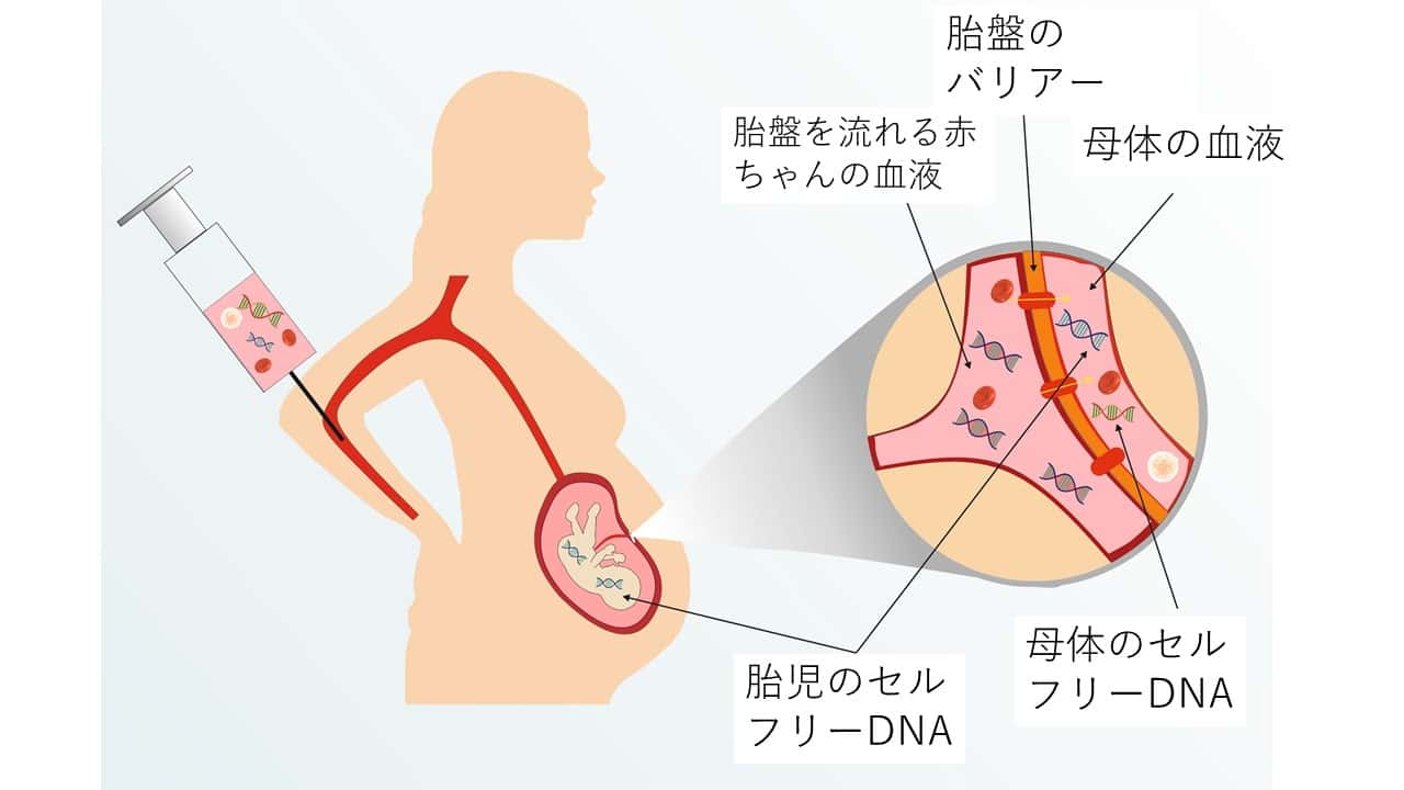 NIPT陽性羊水検査せず中絶｜羊水検査まで待てない