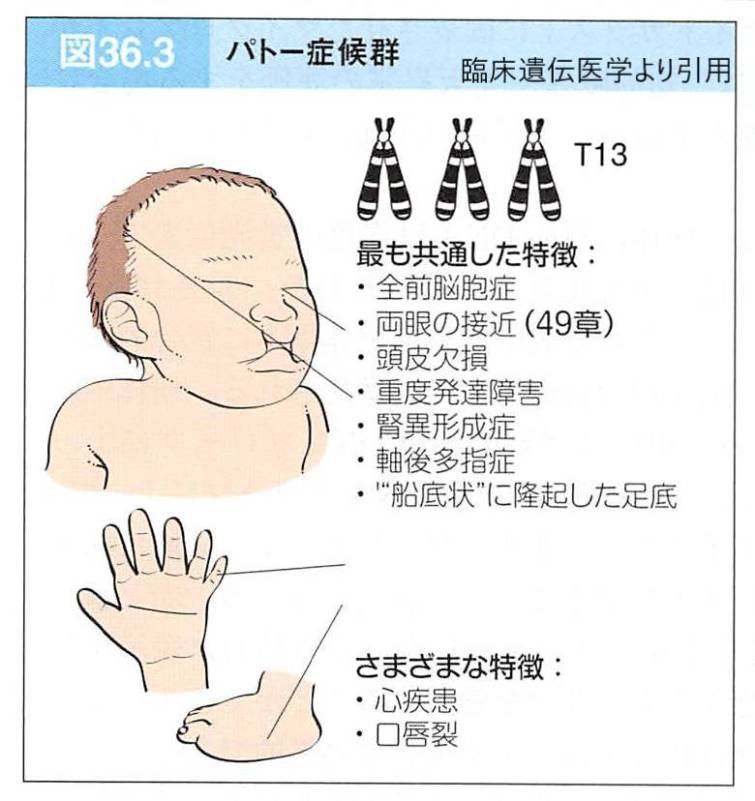 13トリソミー（パトウ症候群）とは？顔貌・特徴・寿命・確率を現役医師が解説