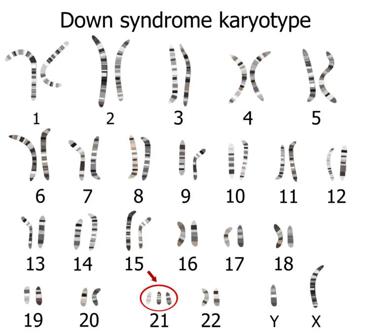 ダウン症候群（21トリソミー）の核型